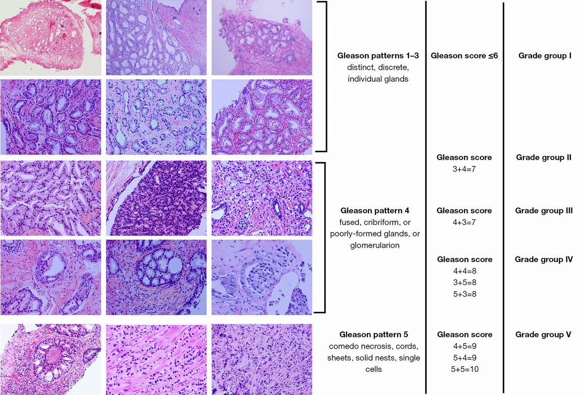 The Evolving Gleason Grading System Chinese Journal Of Cancer Research The Evolving Gleason Grading System Chinese Journal Of Cancer Research