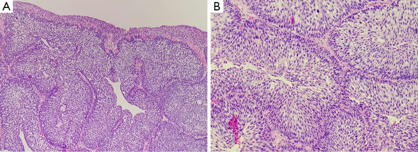 papillary growth of urothelial tumor tenă în tratarea oamenilor