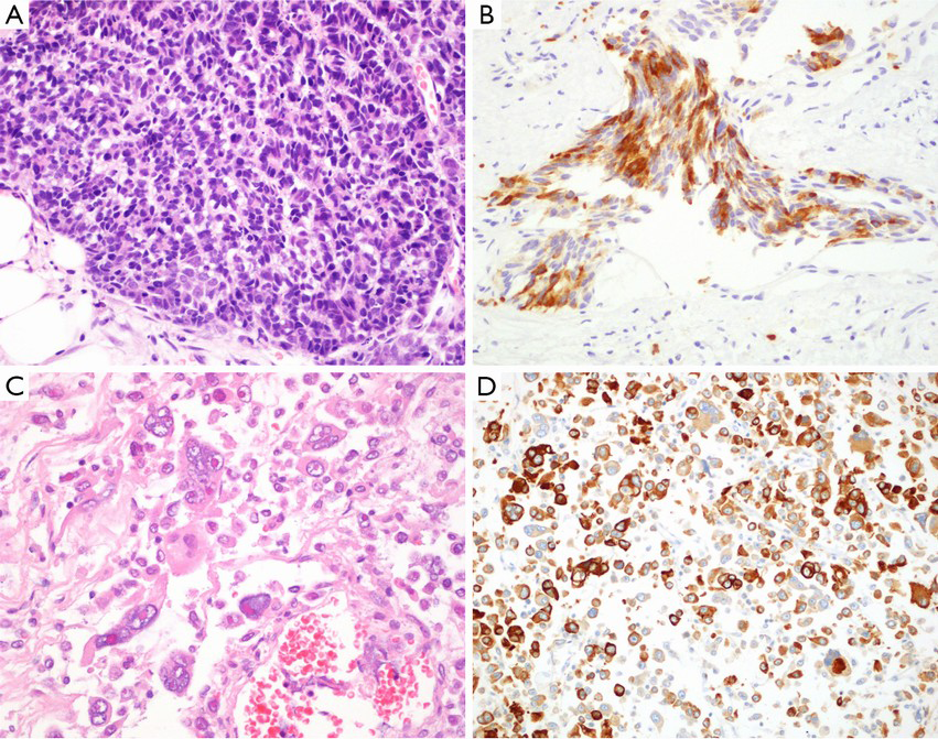 prostate vs urothelial carcinoma immunohistochemistry