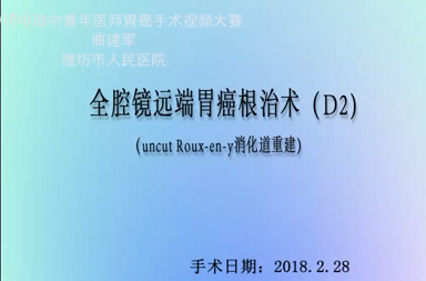 完全腹腔镜远端胃癌根治术（D2）+ uncut roux-en-y消化道重建