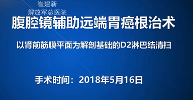 腹腔镜辅助远端胃癌根治术 <br>——以肾前筋膜平面为解剖基础的D2淋巴结清扫