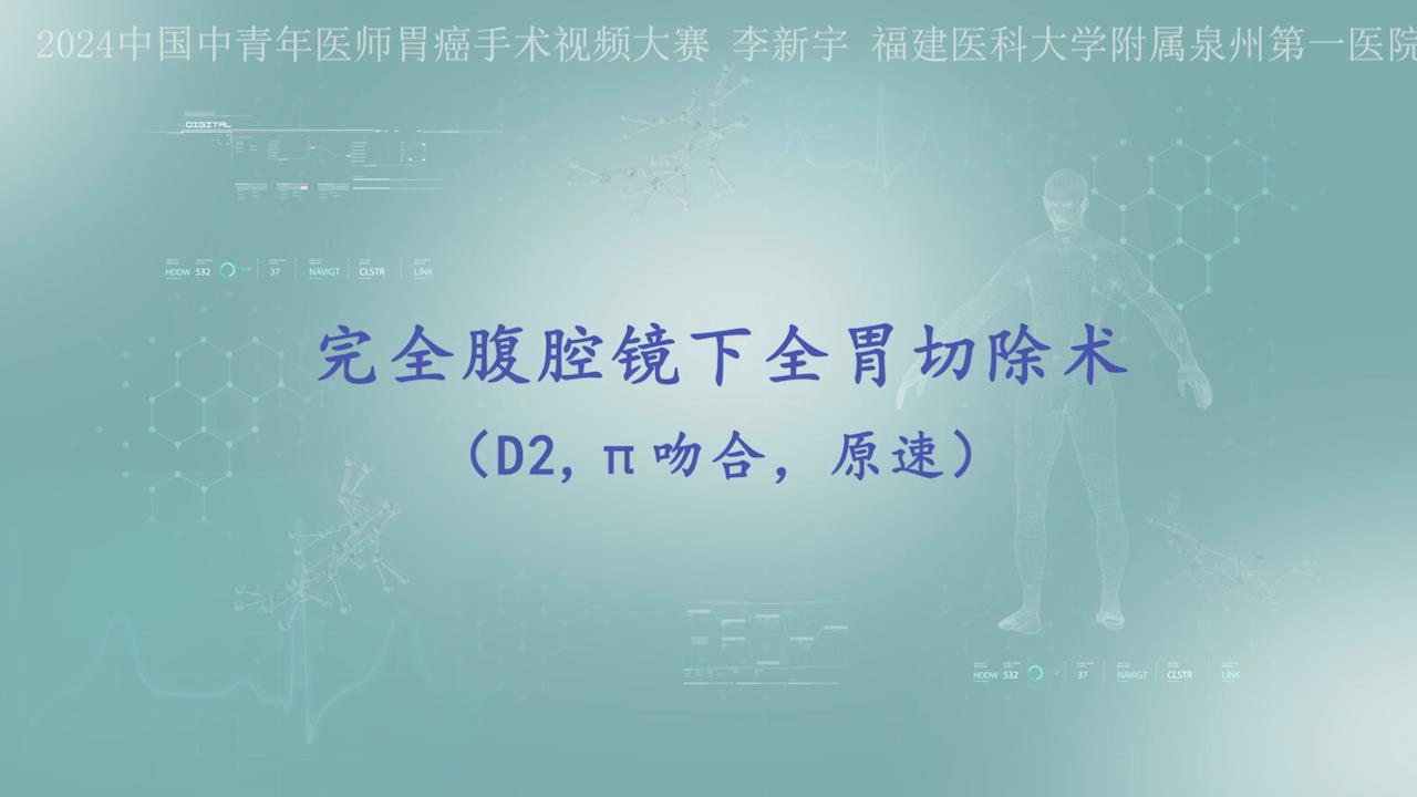 完全腹腔镜全胃切除术（SPLT吻合）