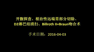 根治性远端胃部分切除、D2淋巴结清扫、Billroth II+Braun吻合术