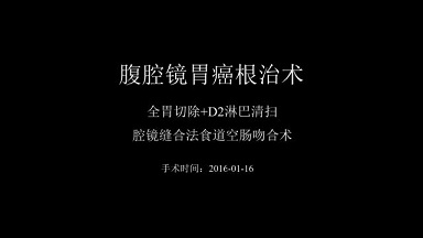 全腹腔镜根治性全胃切除术（D2淋巴清扫+食管空肠手工吻合）