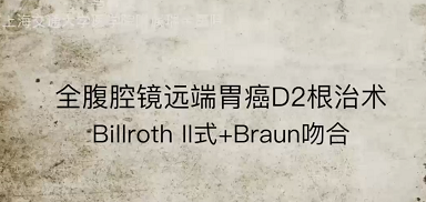 全腹腔镜远端胃癌D2根治术+ Billroth II+Braun吻合