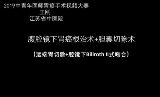 腹腔镜下胃癌根治术+胆囊切除术（远端胃切除+腔镜下Billroth II式吻合）