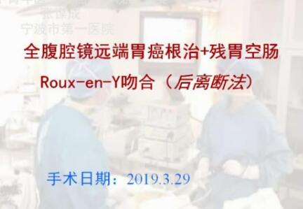 全腹腔镜远端胃癌根治+残胃空肠Roux-en-Y吻合（后离断法）